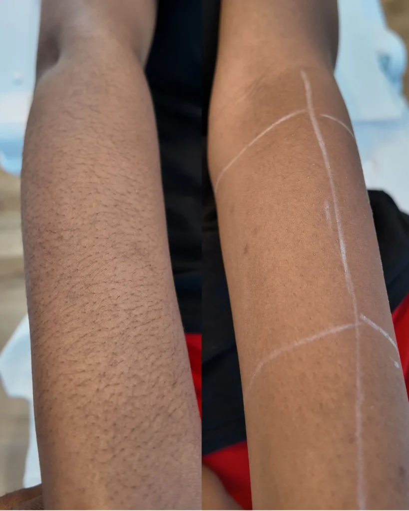 Laser Treatments