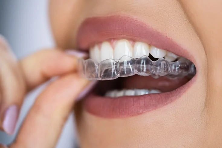 Starlynr Clear Aligners