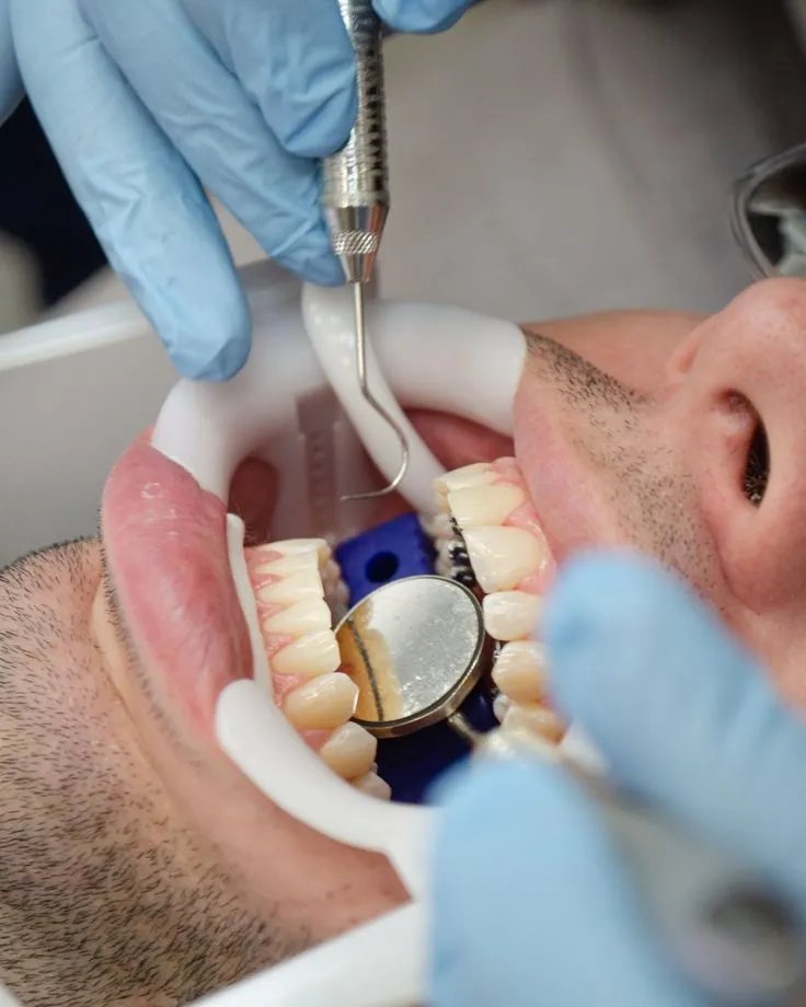Porcelain Veneers